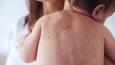 تەندروستی هەولێر هۆشداری لە بڵاوبوونەوەی پەتای “سوورێژە” لەناو منداڵان بڵاودەکاتەوە