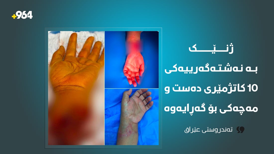 لە بەغدا باسکى بڕدراوی ژنێک دوای 10 کاتژمێر نەشتەرگەری چاندرایەوە
