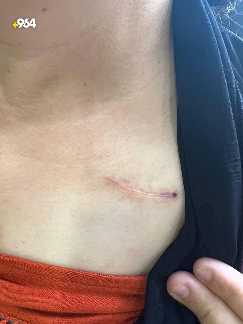 دهوك: 300 مريض يزرعون بطارية لتنظيم دقات القلب.. الضمان 10 سنوات (صور)