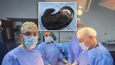 بە نەشتەرگەری؛ تۆپەڵە موویەک لە سکى ژنێکدا دەرهێندرا