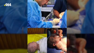 نەشتەرگەریەکى سەرکەوتوو بۆ کۆرپەیەکى تەمەن 20 کاتژمێرى ئەنجامدرا