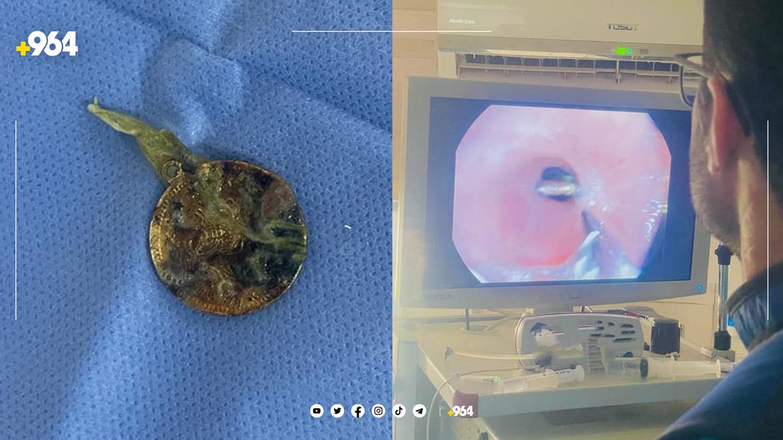 بە نازور تەنێک لە سورێنچکی منداڵێک دەرهێنرا