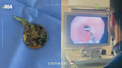 بە نازور تەنێک لە سورێنچکی منداڵێک دەرهێنرا