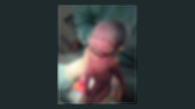 ئەو منداڵەى بە دوو رووخسارەوە لەدایکبوو گیانى لەدەستدا
