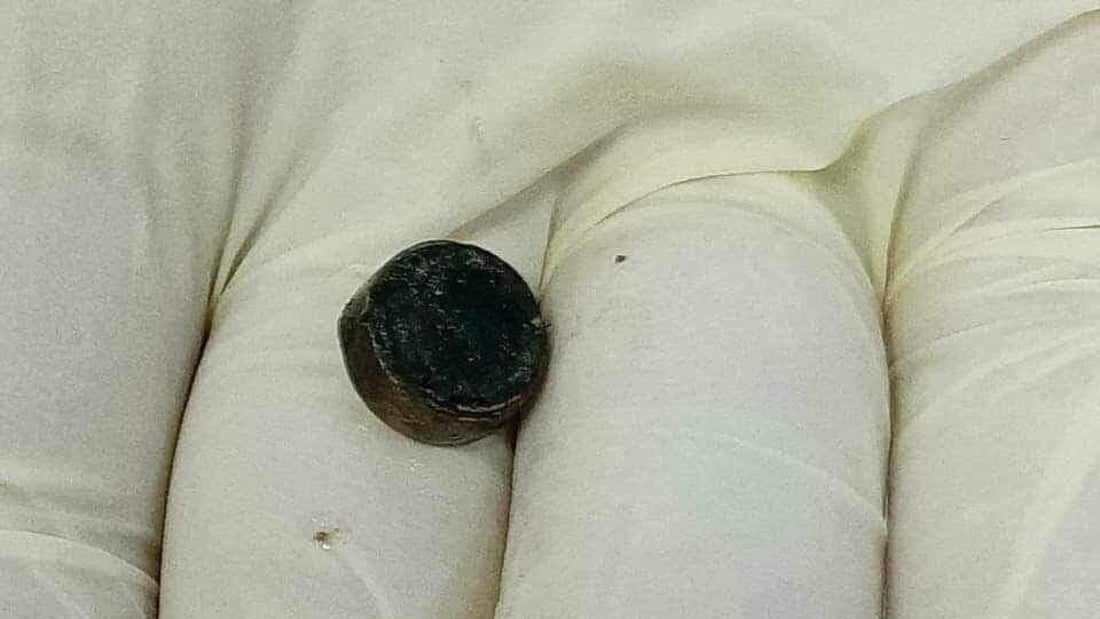بابل: فريق طبي ينجح باستخراج “بطارية” من معدة طفلة تبلغ 11 شهراً
