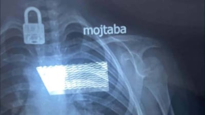 طفل يبتلع “قفل” في النجف.. كوادر مستشفى الزهراء تدخلت بالوقت المناسب