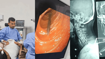 بزمارێک لە گەروی هاوڵاتییەک دەرهێنرا