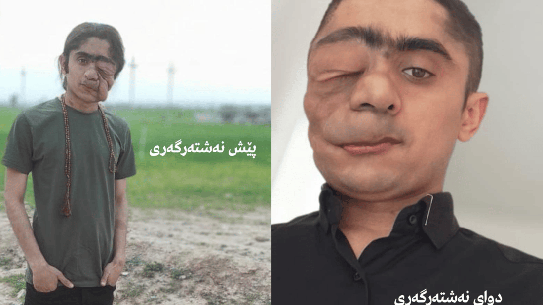 بە نەشتەرگەرییەکی سەرکەوتوو گۆشتی زیادە لەسەر روخساری نەخۆشێک لادرا