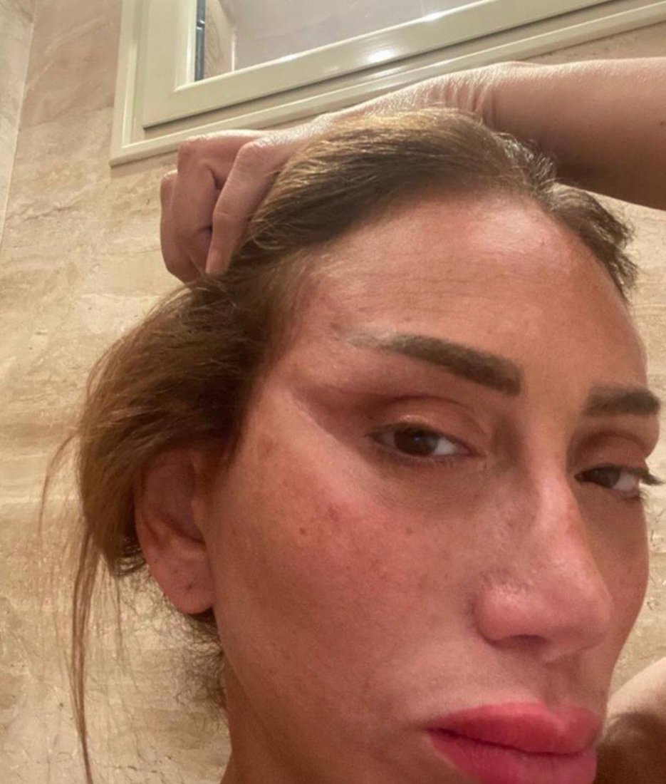 بە هۆی نەشتەرگەری جوانکاری وازی لە بەرنامەکەی هێنا