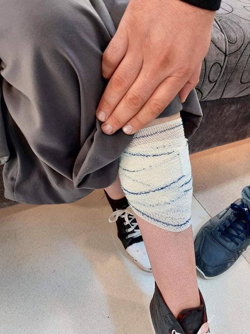 “كلاب الزعفرانية” تنهش فتاة في الـ 15 من عمرها