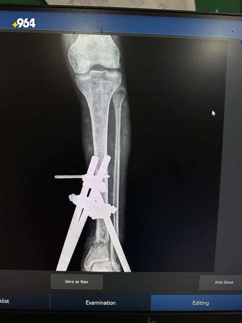 صور: أطباء ينجحون في تثبيت كسر مضاعف أسفل الساق لمصاب في تلعفر