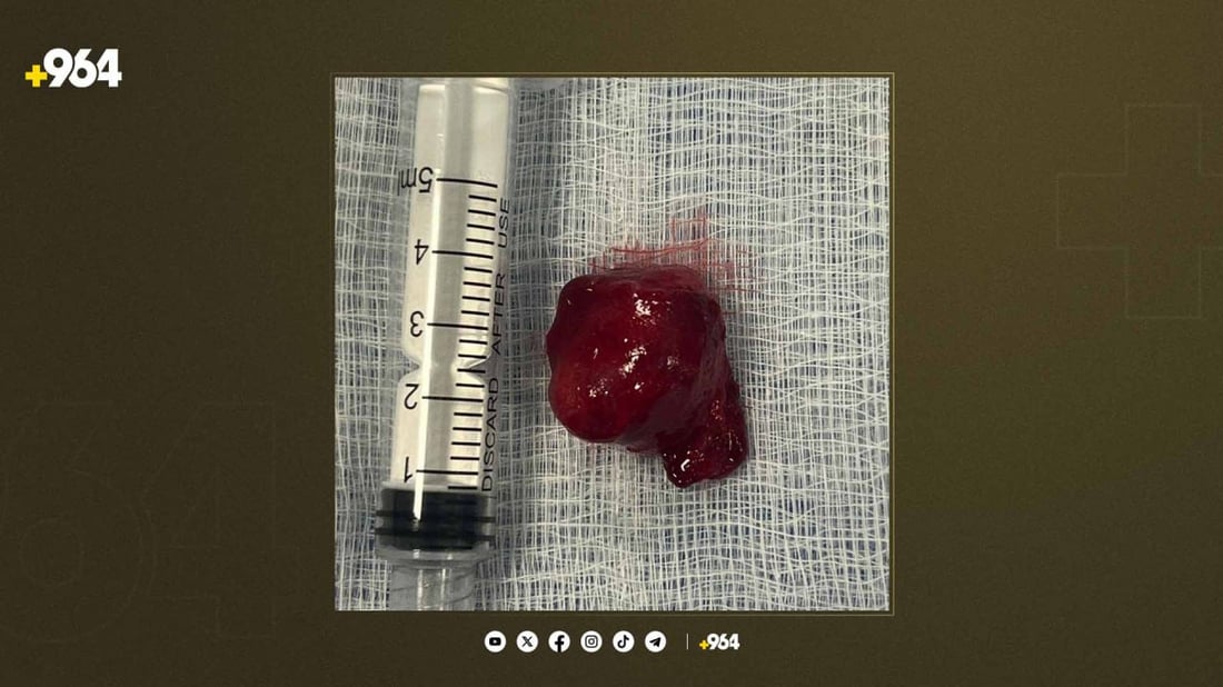 دوو نەشتەرگەریی تایبەت لە سلێمانی ئەنجامدران