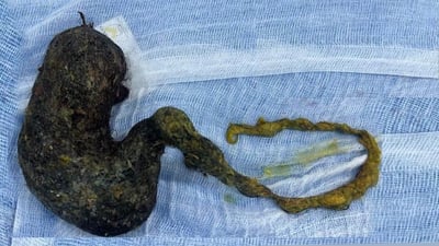 له‌ نه‌شته‌رگه‌رییه‌كى ده‌گمه‌‌ندا كچێك له‌ مردن رزگاركرا