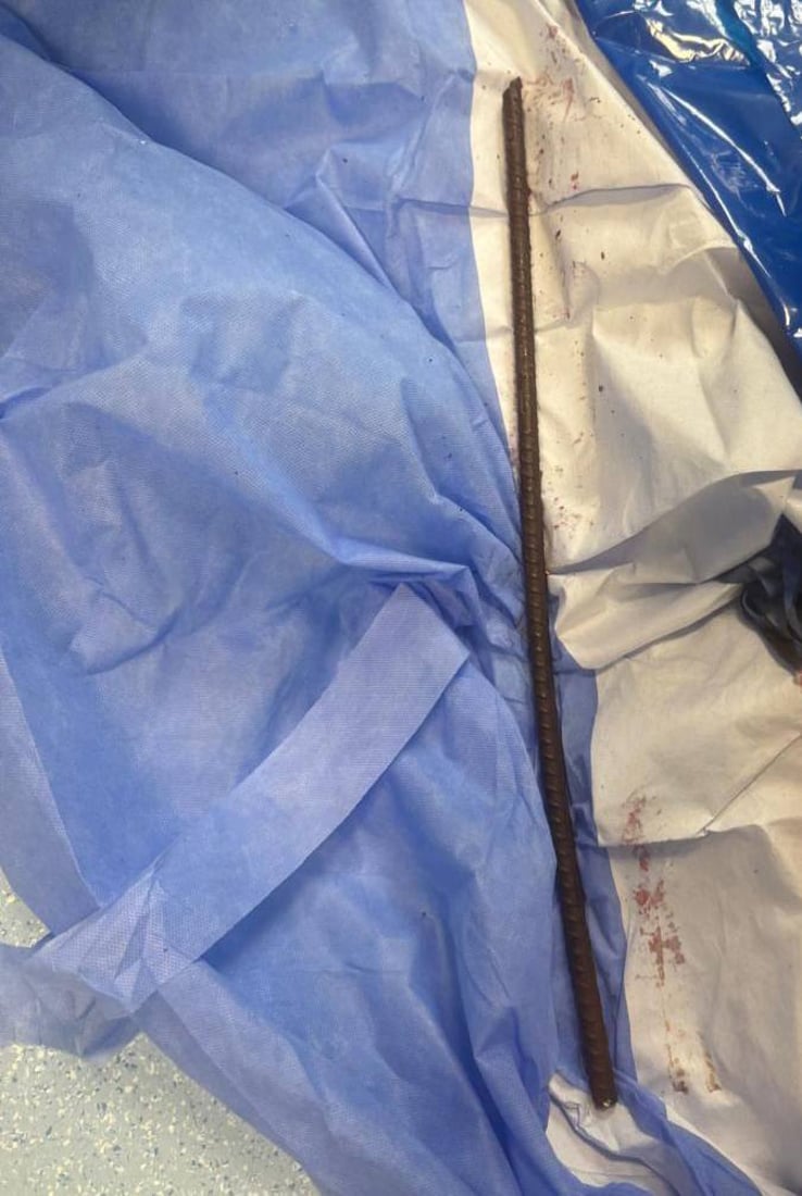 کرێکارێک شیش بە سکیداچوو و لە پشتی هاتەدەرەوە؛ ژیانی بۆ گەڕێندرایەوە