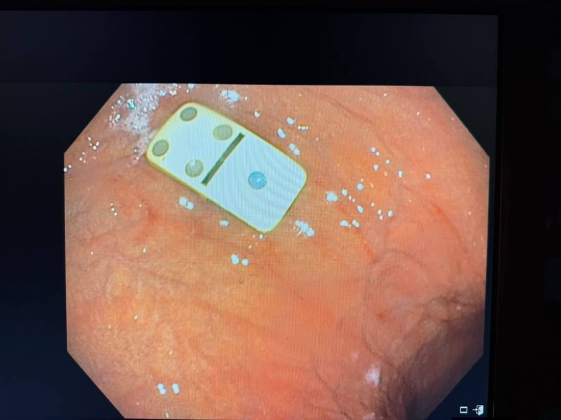 لە سلێمانی پولێکی دۆمینە لە گەدەی مێردمنداڵێک دەرهێنرایەوە