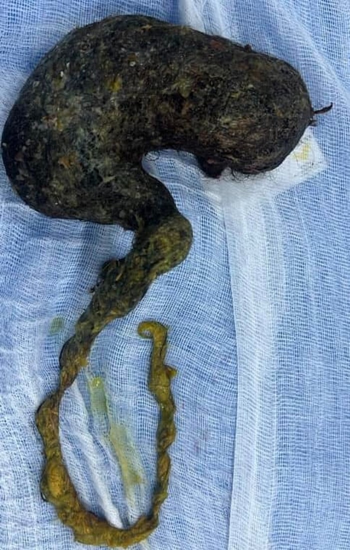 له‌ نه‌شته‌رگه‌رییه‌كى ده‌گمه‌‌ندا كچێك له‌ مردن رزگاركرا