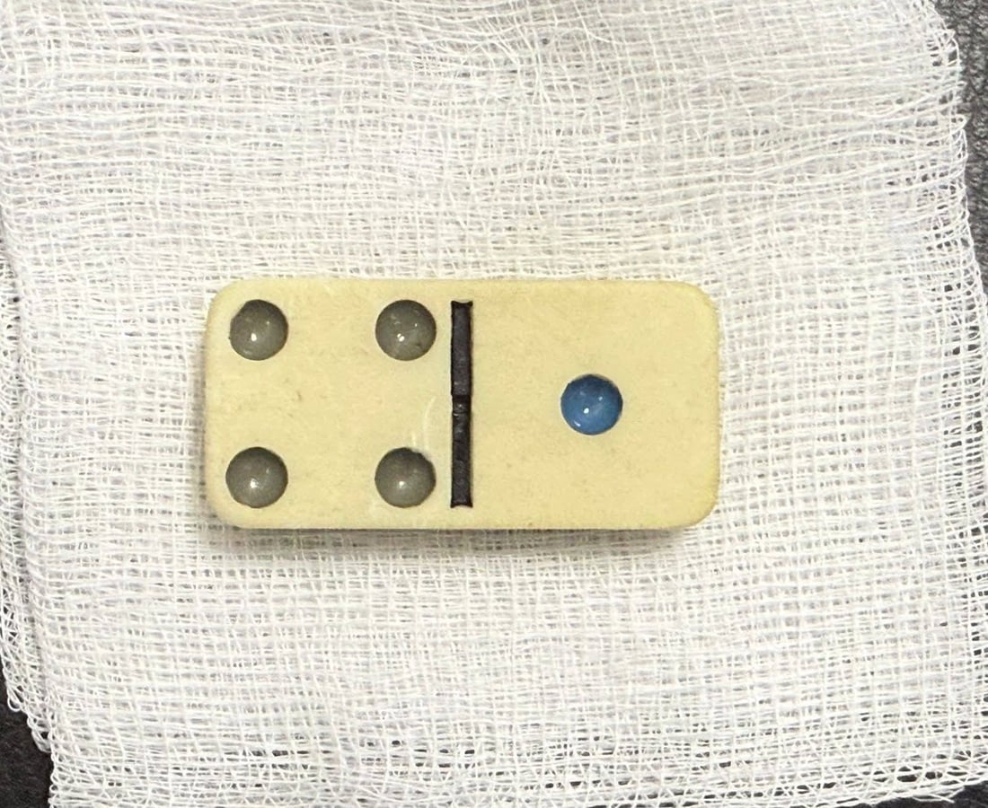 لە سلێمانی پولێکی دۆمینە لە گەدەی مێردمنداڵێک دەرهێنرایەوە