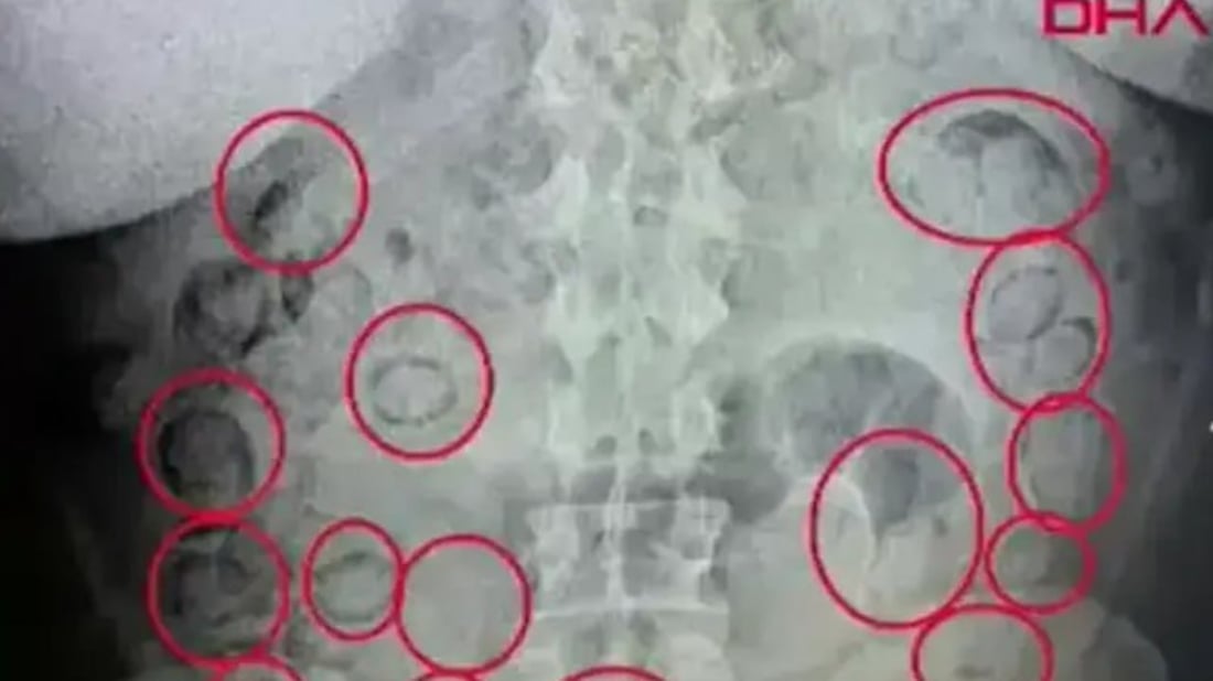 433 گرام ماددەی هۆشبەر لە ناو “گەدە”ی بوو