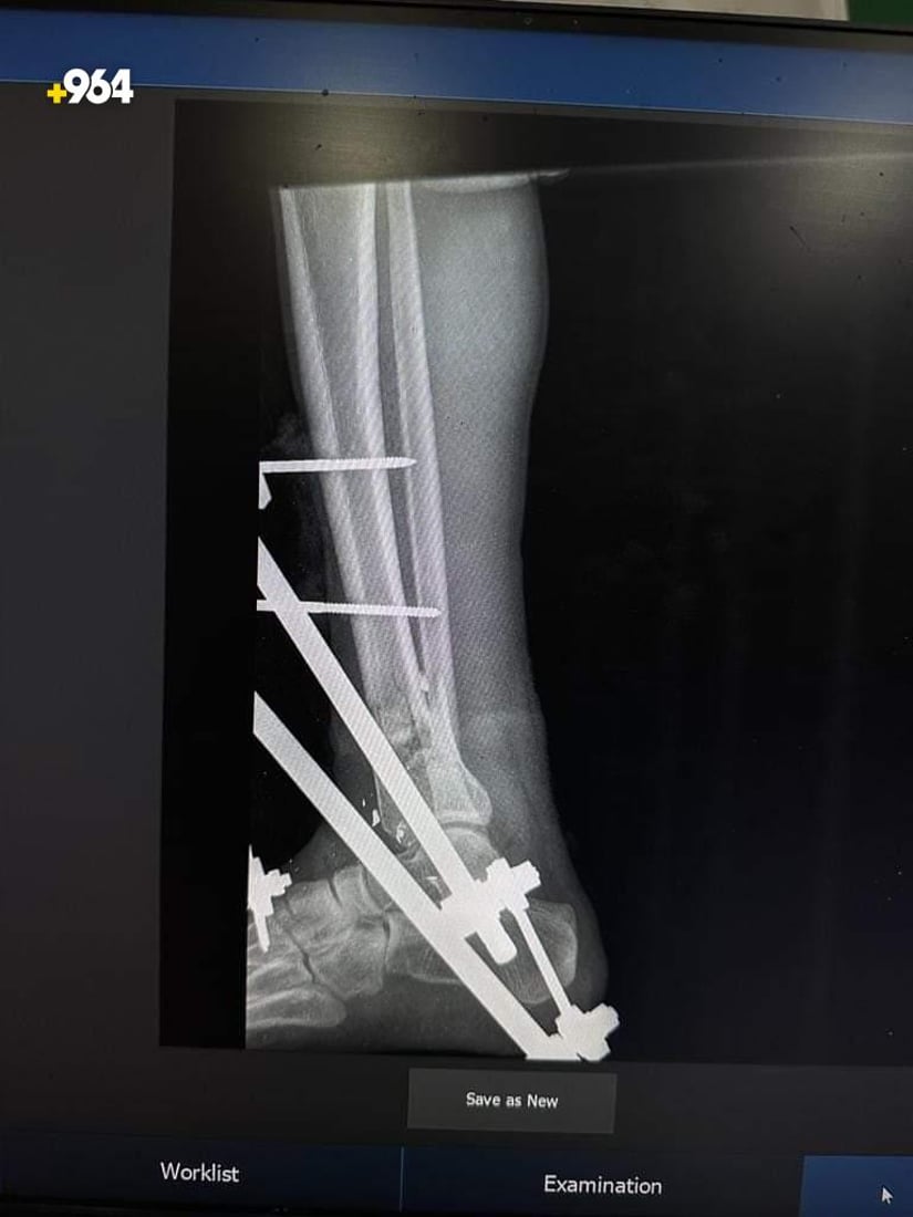 صور: أطباء ينجحون في تثبيت كسر مضاعف أسفل الساق لمصاب في تلعفر