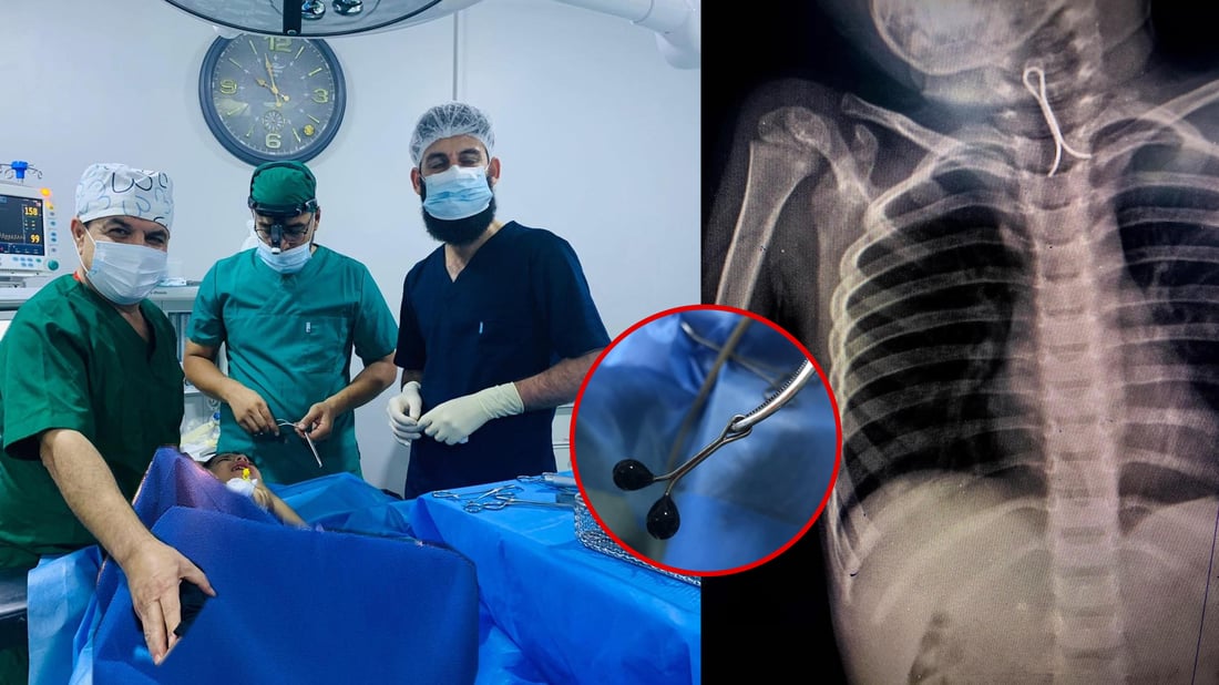 تەوقەیەکی قژ لە قوڕگی منداڵێک دەرهێنرا