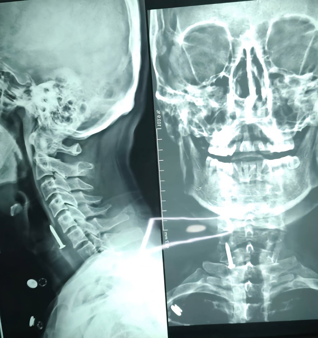 إنقاذ شاب ثلاثيني ابتلع “مسمار” في السليمانية