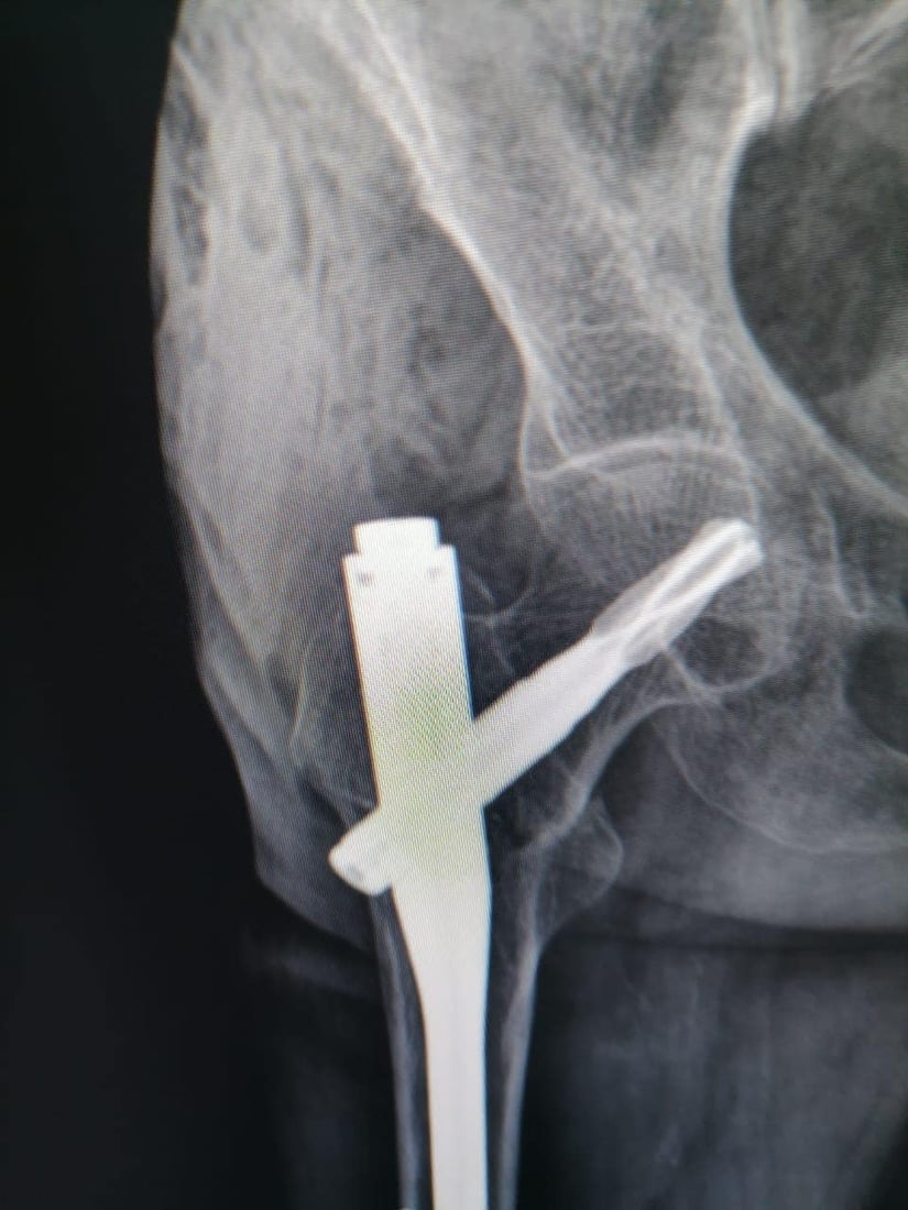 نه‌شته‌رگه‌رى بۆ ژنێكى ته‌مه‌ن 95 ساڵ به‌ سه‌ركه‌وتوویی ئه‌نجامدرا