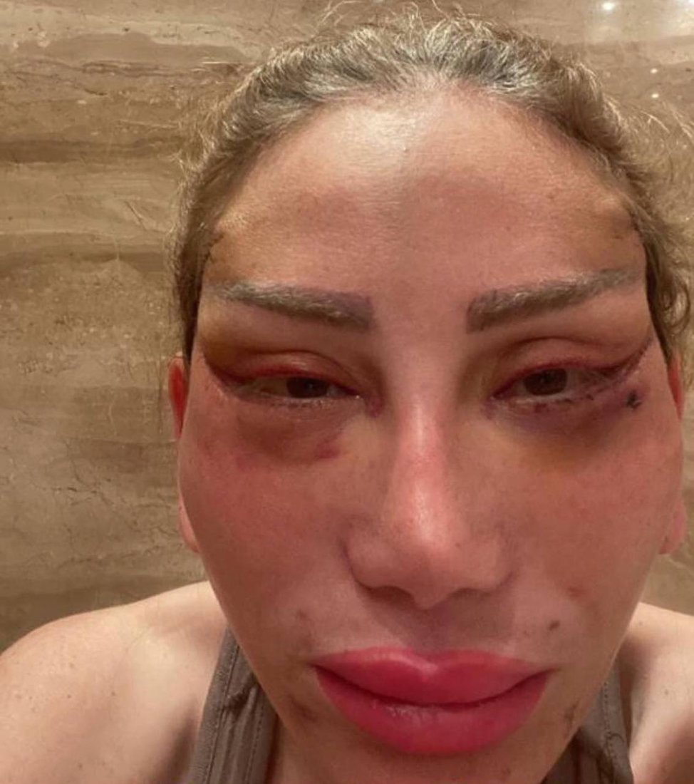 بە هۆی نەشتەرگەری جوانکاری وازی لە بەرنامەکەی هێنا