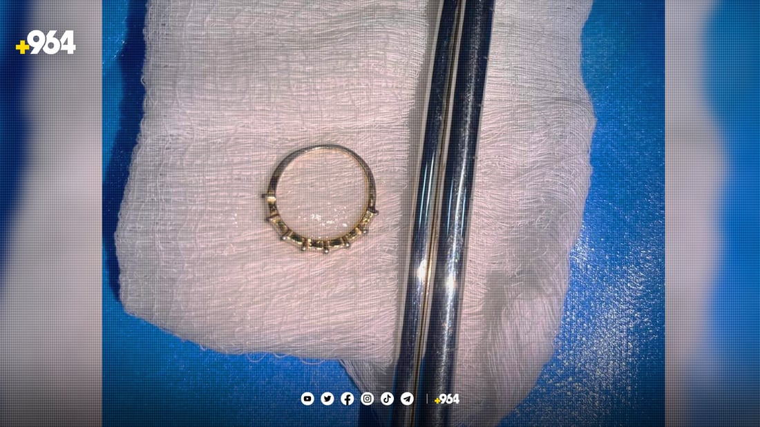 مستیلەیەک لە سورێنچکی منداڵێک دەرهێنرا