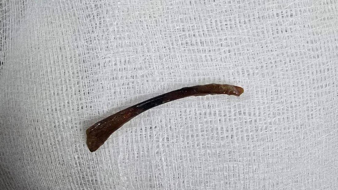 دوای دوو ساڵ پارچە ئێسکێک لە ڕیخۆڵەی نەخۆشێک دەرهێنرا