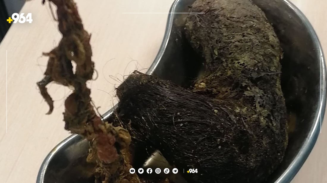 تۆپەڵێک موو لە گەدەی کچێک دەرهێندرا