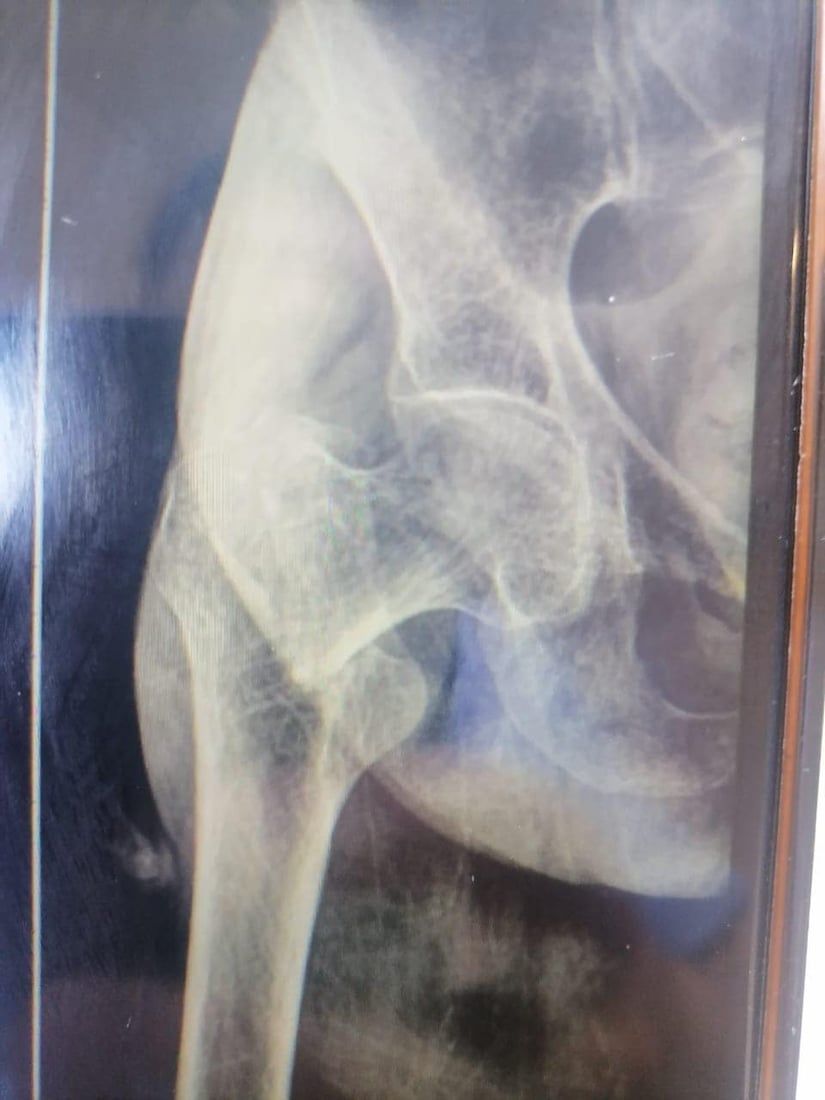 نه‌شته‌رگه‌رى بۆ ژنێكى ته‌مه‌ن 95 ساڵ به‌ سه‌ركه‌وتوویی ئه‌نجامدرا