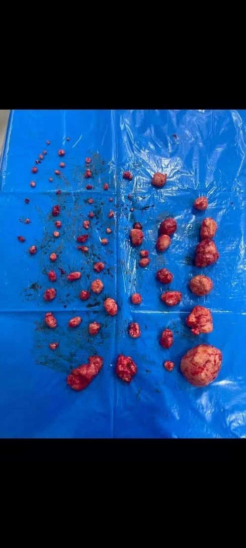 لە قەڵادزێ: زیاتر لە 70 گرێ لە منداڵدانى ژنێک دەرهێندرا