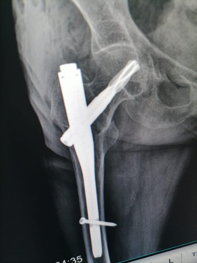 نه‌شته‌رگه‌رى بۆ ژنێكى ته‌مه‌ن 95 ساڵ به‌ سه‌ركه‌وتوویی ئه‌نجامدرا