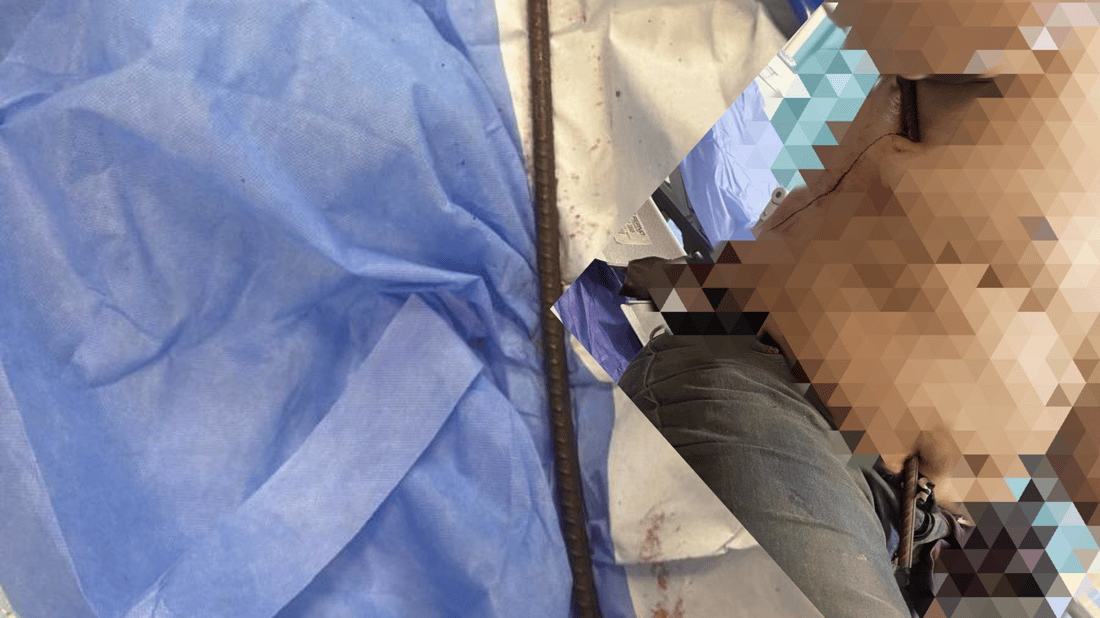 کرێکارێک شیش بە سکیداچوو و لە پشتی هاتەدەرەوە؛ ژیانی بۆ گەڕێندرایەوە