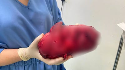 بە لابردنى گرێیەکى 20 سانتیمەترى هیوا بۆ دایکێک گەڕێندرایەوە