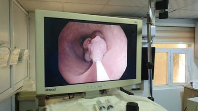 بەبێ نەشتەرگەری، گرێیەکی 6 سانتیمەتری کۆلۆن لابرا