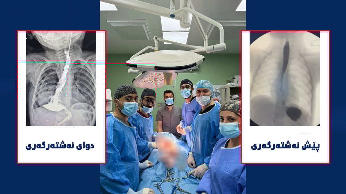 لە کەرکوک بۆرییەکی نوێی خۆراکدان بۆ کچێکی دوو ساڵان دروستکرا