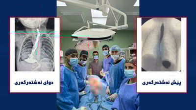 لە کەرکوک بۆرییەکی نوێی خۆراکدان بۆ کچێکی دوو ساڵان دروستکرا