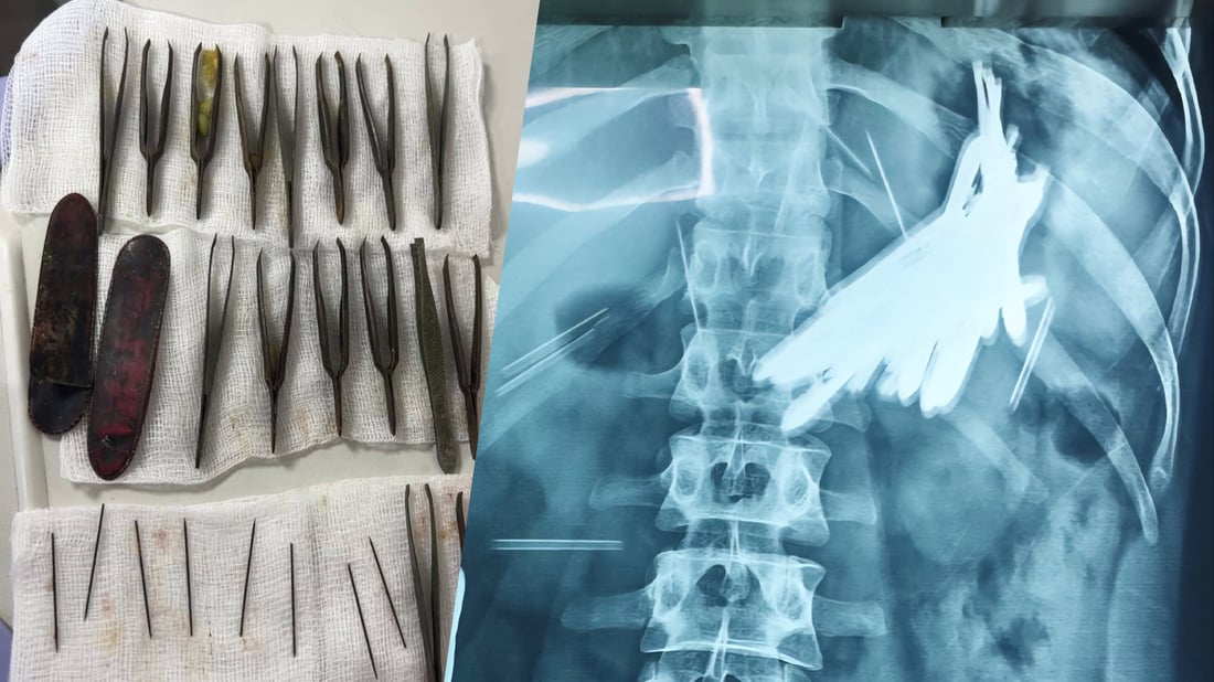 له‌ سلێمانى 24 ده‌رزى و موكێش له‌ جه‌سته‌ى نه‌خۆشێك ده‌رهێندران