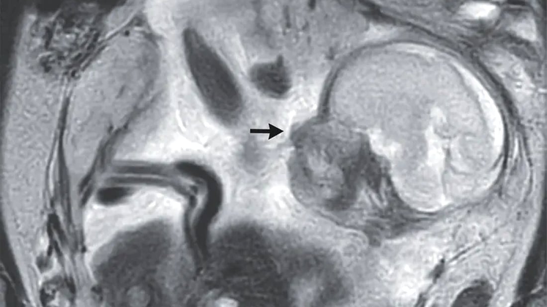 منداڵێک لە دەرەوەی منداڵدان دروست بوو