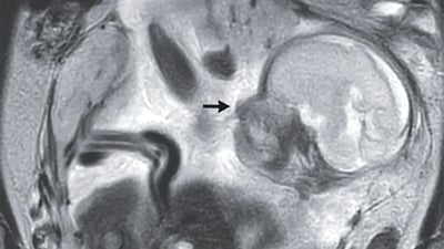 منداڵێک لە دەرەوەی منداڵدان دروست بوو