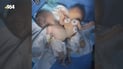 Kirkuk doctors perform first conjoined-twin separation, saving surviving newborn