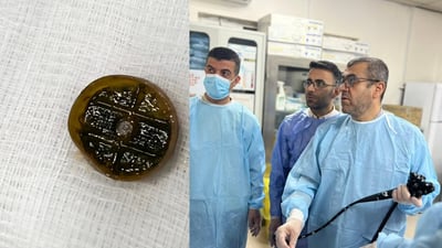 سەرى قوتوى دەرمانێک لە گەدەى ژنێک دەرهێندرا