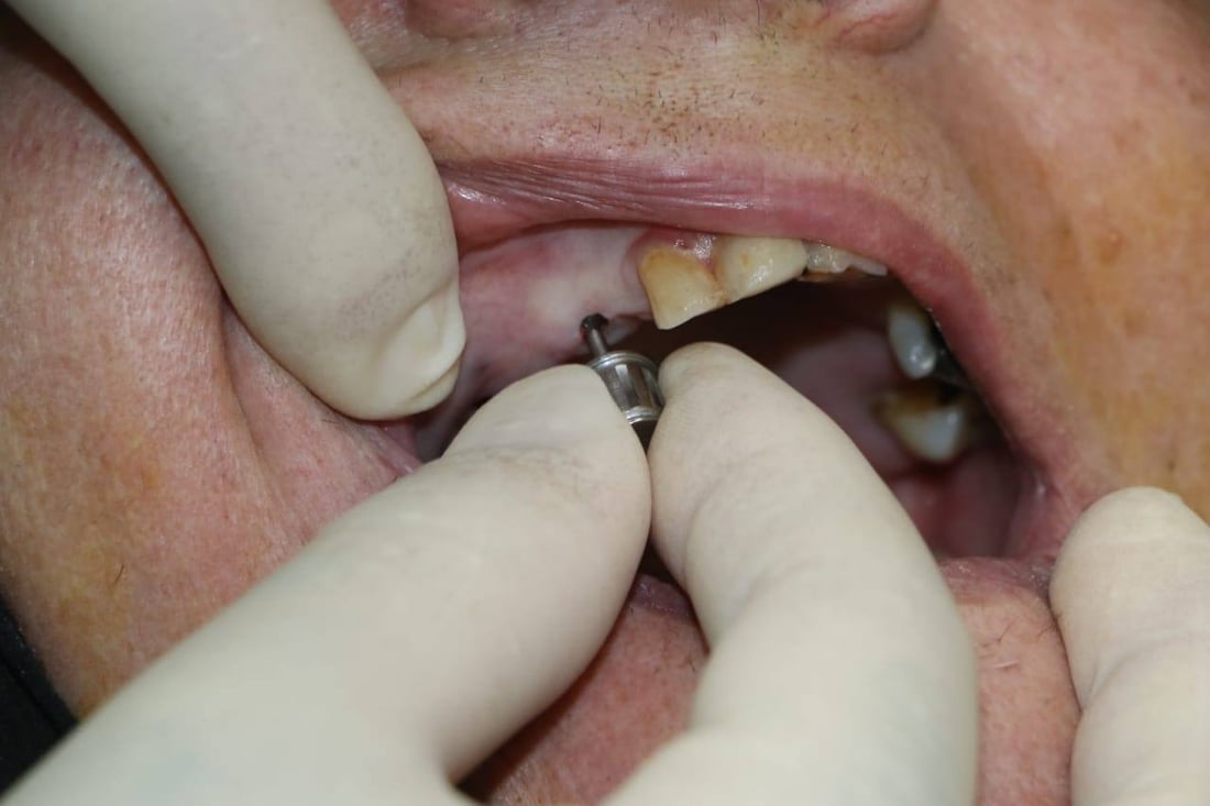 بۆ یەکەمجار لە نەخۆشخانەی ئازادی دهۆک چاندنی ددان بە تەکنیکی نوێ دەستیپێکرد