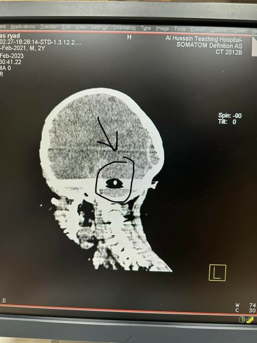 الرميثة: رصاصة احتفالات الجيران تفقد عباس وعيه والأطباء قلقون على صحته
