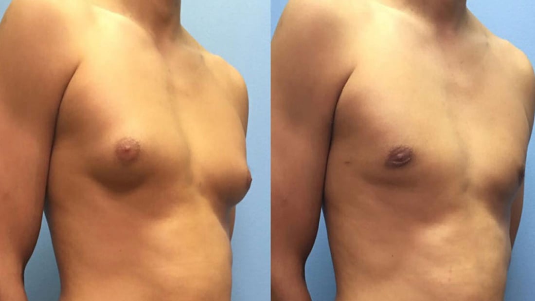 پیاوان لە چ کاتێکدا لە گەورەبوونی مەمکیان بترسن؟ 