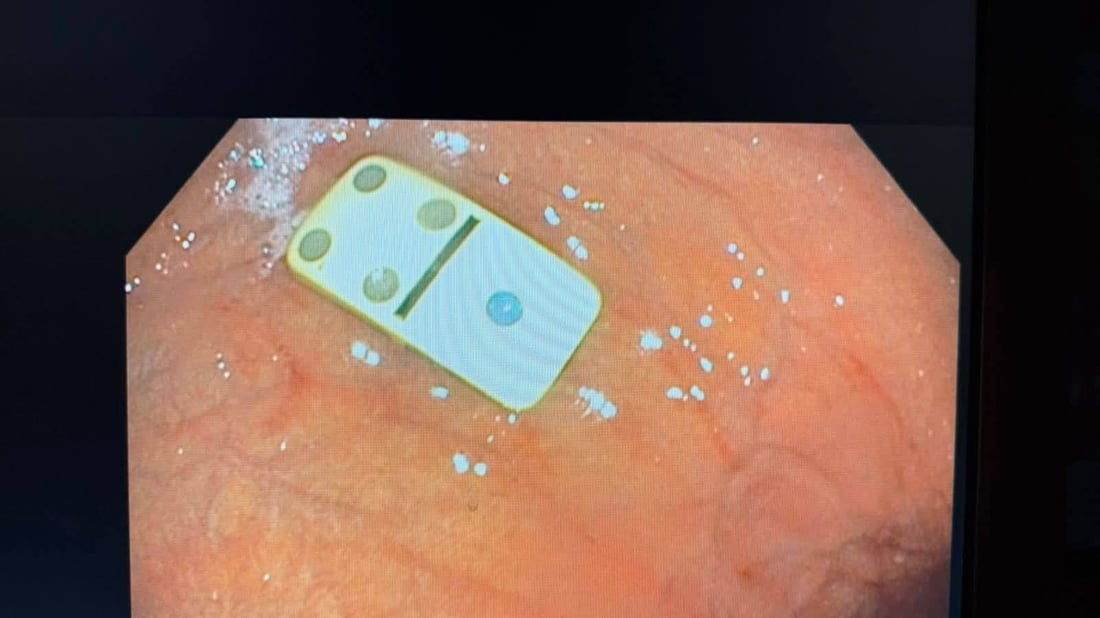 لە سلێمانی پولێکی دۆمینە لە گەدەی مێردمنداڵێک دەرهێنرایەوە