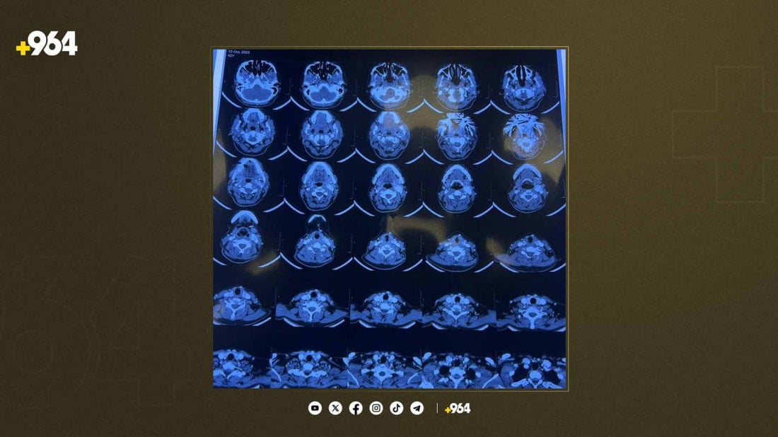 دوو نەشتەرگەریی تایبەت لە سلێمانی ئەنجامدران