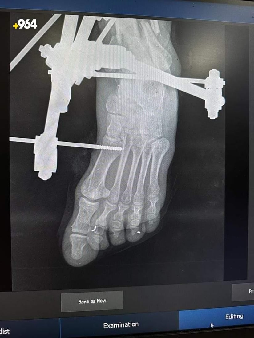 صور: أطباء ينجحون في تثبيت كسر مضاعف أسفل الساق لمصاب في تلعفر