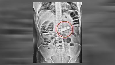 مۆبایلێک لە گەدەی كەسێک دەرهێنرا